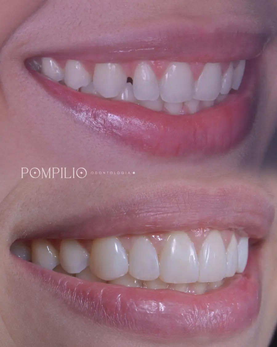 Facetas em resina em Recife — correção estética rápida