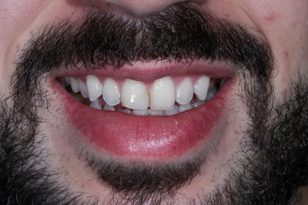 Realinhamento e Clareamento com Facetas de Porcelana em Recife — antes do tratamento